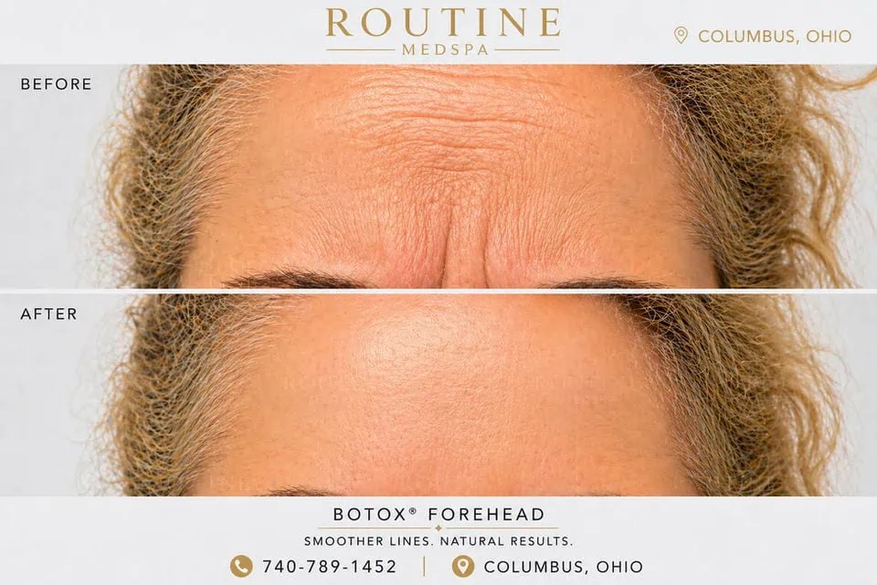 Before and After Treatment a