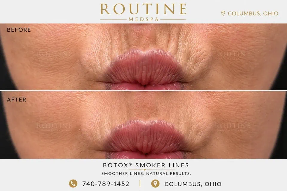 Before and After Treatment c